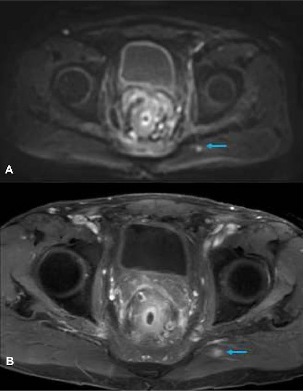 MRI CT PET Scans - Adenocarcinoma 3T v 1.5T MRI CT PET Scans - Adenocarcinoma 3T v 1.5T