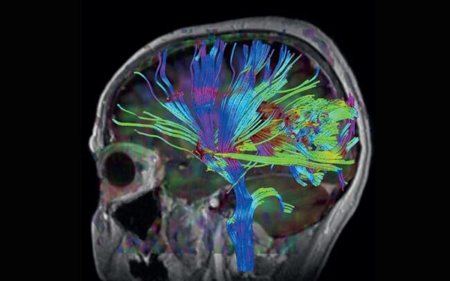 Neurology Brain MRI Scan