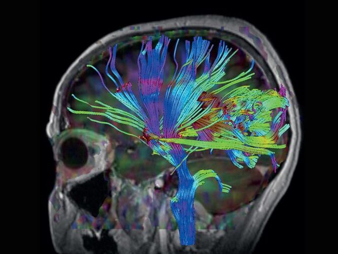 Neurology Brain MRI Scan