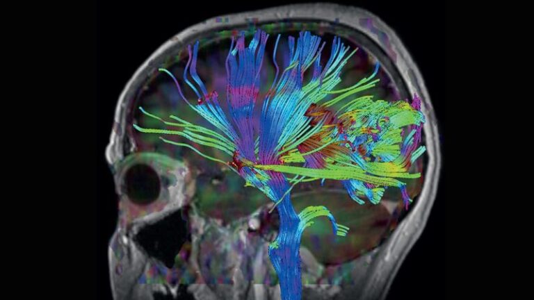 Neurology Brain MRI Scan