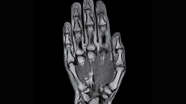 Orthopedic Hand MRI Diagnostic Imaging