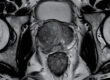 Prostate MRI Scan