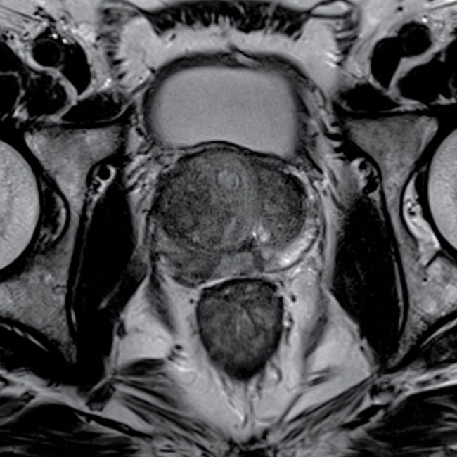 Prostate MRI Scan Prostate MRI Scan
