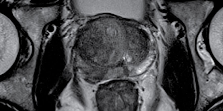 Prostate MRI Scan