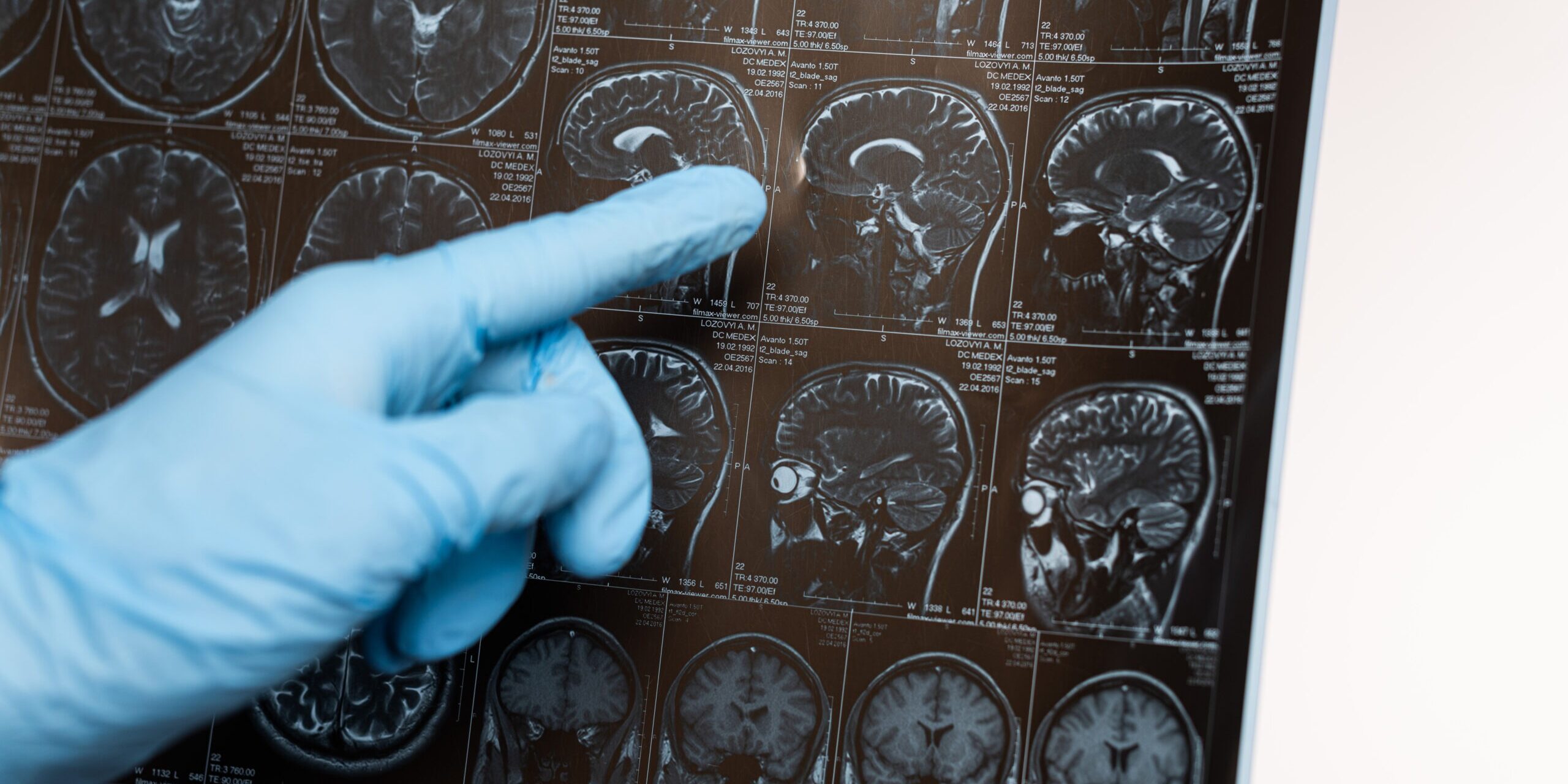 Cropped view of doctor pointing on magnetic resonance imaging of brain isolated on white, alzheimer